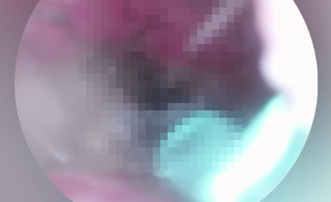 耳からクモを取り出すも痛みが続いていた女性が病院へ行く → 医者からヤバイ事実を告げられる・・・-同舟