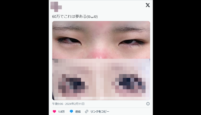 整形した女子高生「60万でこれは夢ある」ﾊﾟｼｬｯ→リプ欄が地獄と化してしまう・・・-同舟