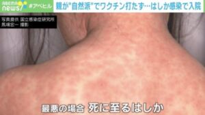 ワクチンを嫌う“自然派ママ”、はしかで死ぬほど苦しんだ娘に最悪な言葉を放つ・・・-同舟